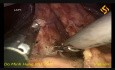 Laparoscopic Distal Gastrectomy with D2 Lymphadenectomy