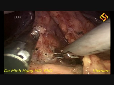 Laparoscopic Distal Gastrectomy with D2 Lymphadenectomy