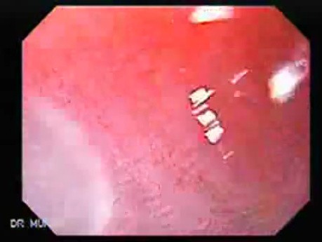 Barrett Esophagus - endoscopic view  (3 of 9)