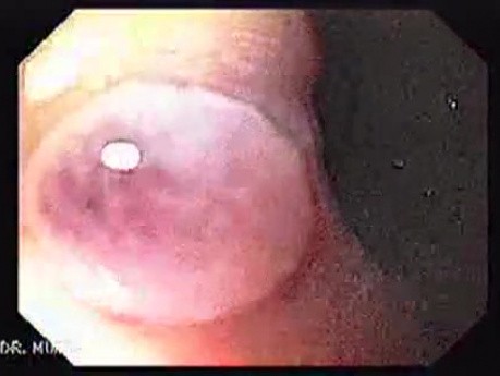 Longstanding gastroesophageal reflux disease (3 of 7)