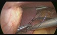 One Anastomosis Gastric Bypass (OAGB)
