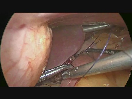 One Anastomosis Gastric Bypass (OAGB)