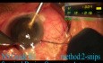 Quick Phacoemulsification 2