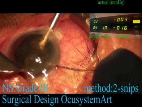 Quick Phacoemulsification 2
