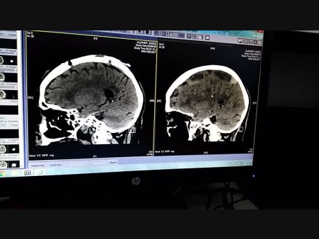 Rt Hemispheric Multiseptated Chronic SDH