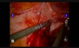 Endometriosis Resection