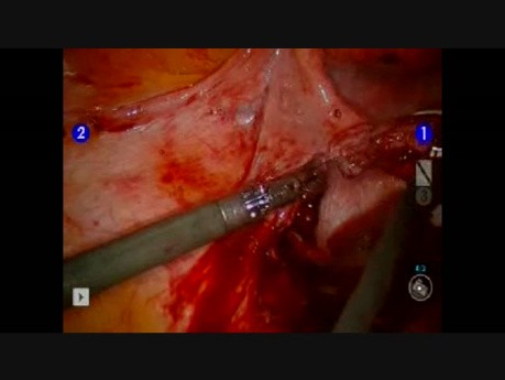Endometriosis Resection