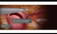 Laparoscopic Myomectomy Animation 3 Layer Closure with Bidirectional Quill® Barbed Suture