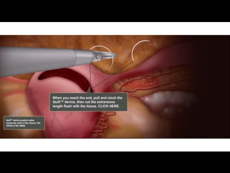 Laparoscopic Myomectomy Animation 3 Layer Closure with Bidirectional Quill® Barbed Suture