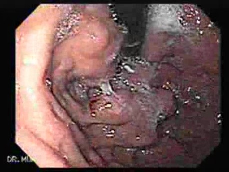 Gastro-Esophageal Varices - Large Varices of the Cardias