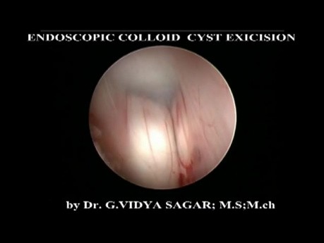 Endoscopic Colloid Cyst Excision