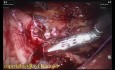 Pediatric Retroperitoneoscopic Robotic Pyeloplasty for Crossing Vessel PUJO