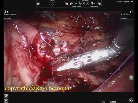 Pediatric Retroperitoneoscopic Robotic Pyeloplasty for Crossing Vessel PUJO