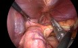 Wedge Gastrectomy for Subcardial GIST