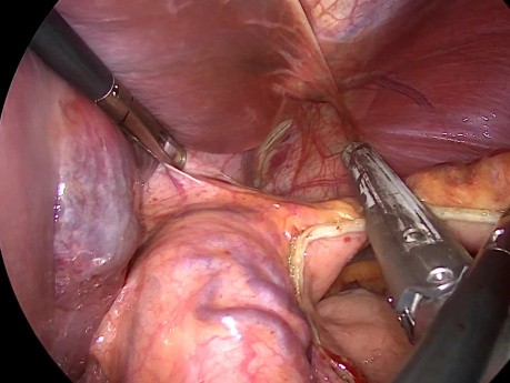 Wedge Gastrectomy for Subcardial GIST