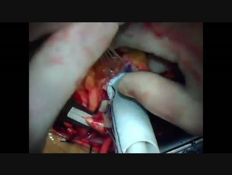 Modified Bental Procedure For Annuloaortic Ectasia And Aortic Insufficiency