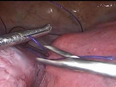 Multiple Fibroids