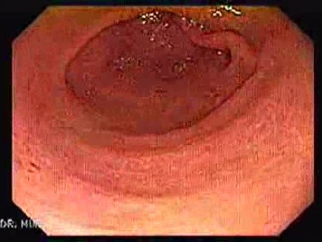Pylorus