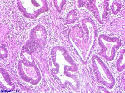 Rectal Adenocarcinoma (6 of 7)