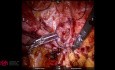 Robotic Repair of a Traumatic Abdominal Wall Hernia