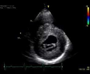 Hypertrophic Cardiomyopathy