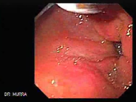 Adenocarcinoma of the Cardia and Carcinoma Epidermoid of the Larynx (14 of 26)