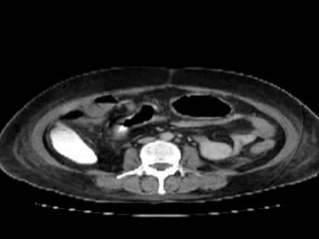 Multiple Rectal Ulcers (48 of 110)
