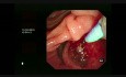 ERCP: Needle Knife Sphincterotomy for Impacted Stone