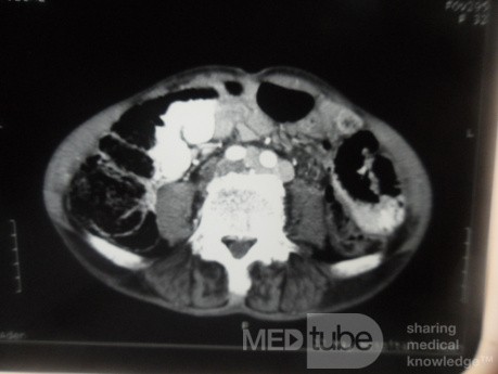 Pancreas cancer - 6
