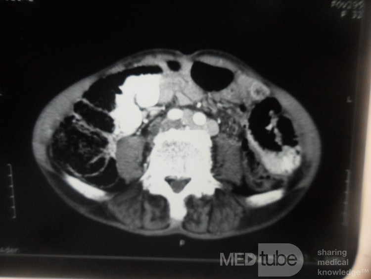 Pancreas cancer - 6