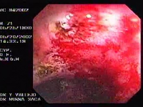 Radiation Proctosigmoiditis (14 of 14)