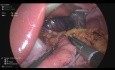 Laparoscopic One Anastomosis Gastric Bypass Plus Repair of Hiatus Hernia and Cholecystectomy