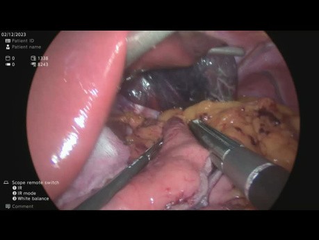 Laparoscopic One Anastomosis Gastric Bypass Plus Repair of Hiatus Hernia and Cholecystectomy