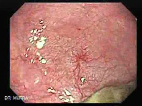 Zenker's Diverticulum - 75 Years-Old Male