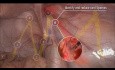 Critical View of Myopectineal Orifice (MPO) - Essential Steps