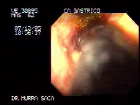 Gastric Carcinoma With Superficial Mucosal Necrosis
