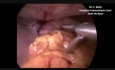 Laparoscopic Treatment for Perforated Bleeding Gastric Ulcer