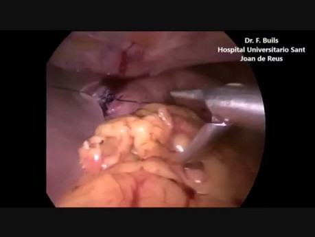 Laparoscopic Treatment for Perforated Bleeding Gastric Ulcer