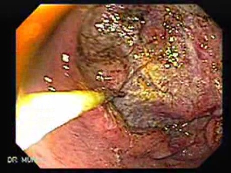 Adenocarcinoma of the Antrum (4 of 5)