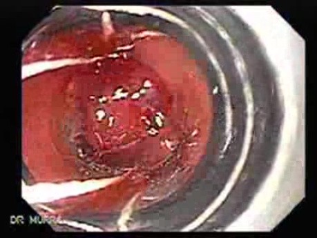 Duodenal Ulcer and Bleeding (9 of 23)