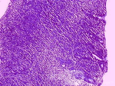 Gastric Lymphoma (7 of 10)