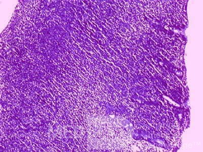 Gastric Lymphoma (7 of 10)