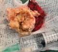 Epicranial Tumor Injury