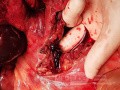 Mesenterial Venous Thrombosis