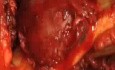 Ameloblastoma