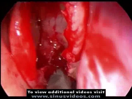 Concha Bullosa Resection
