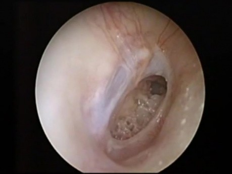 Large Center Eardrum Perforation