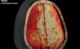 Osteoplastic Craniotomy in a Case of Acute Spontaneous Subdural Hemorrhage