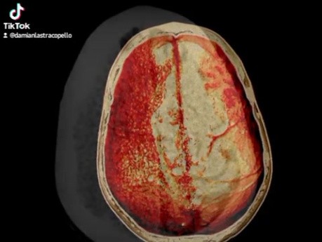 Osteoplastic Craniotomy in a Case of Acute Spontaneous Subdural Hemorrhage