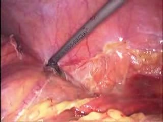 Laparoscopic Left Hemicolectomy Due To Colon tumor